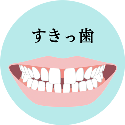 すきっ歯