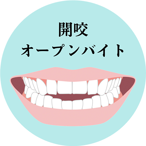 開咬