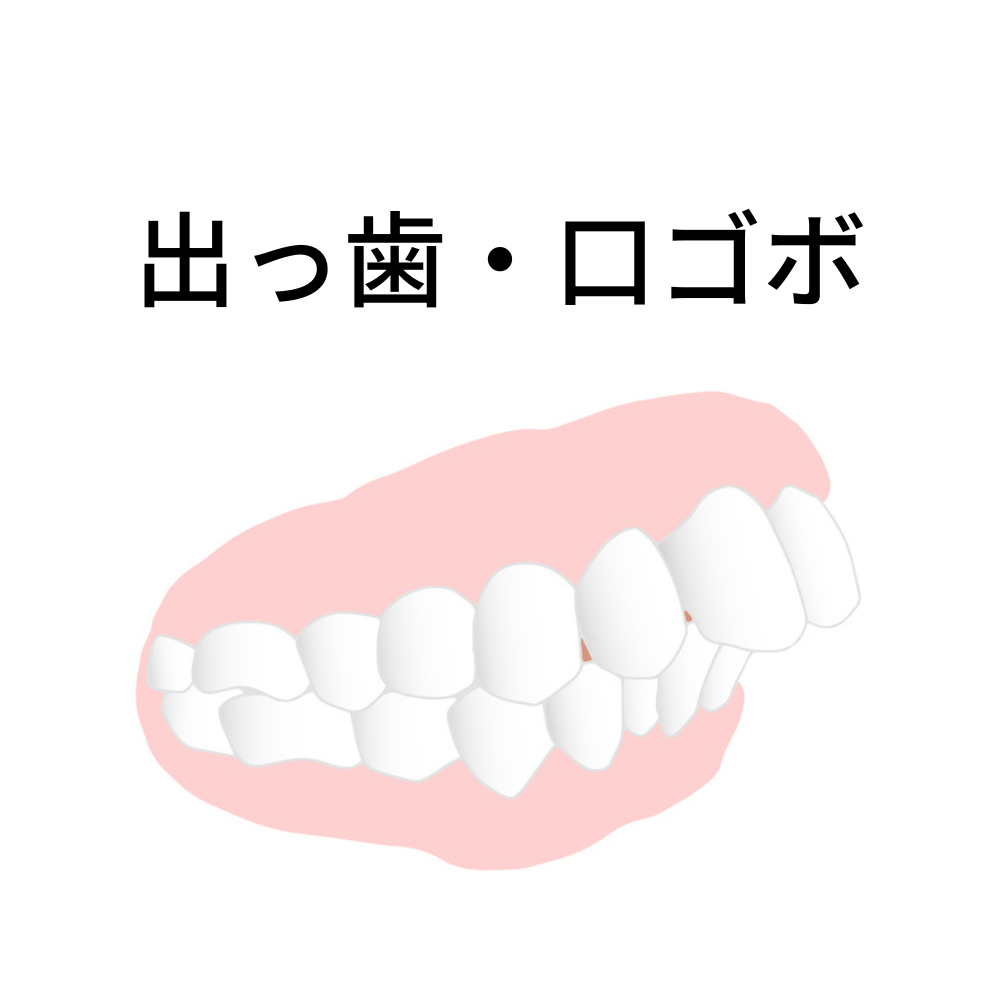 出っ歯のインビザラインで後悔・失敗しないために