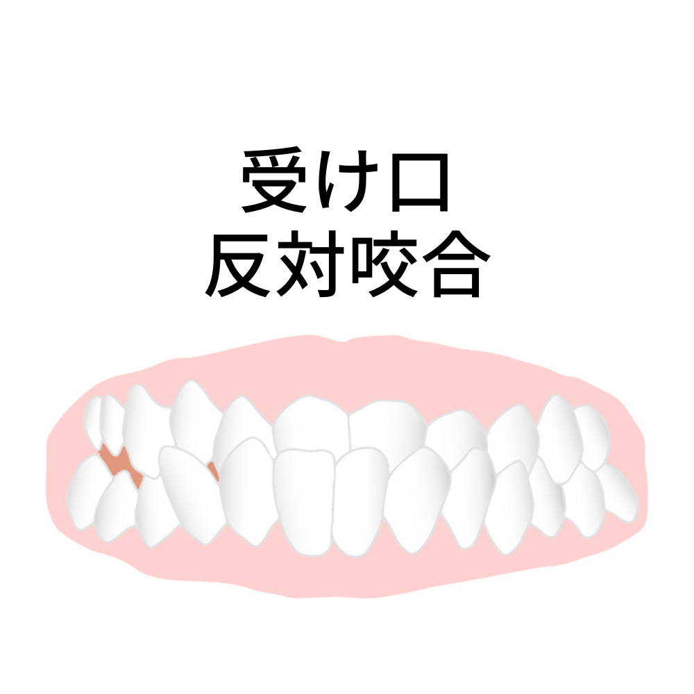 受け口のインビザラインで後悔・失敗しないために