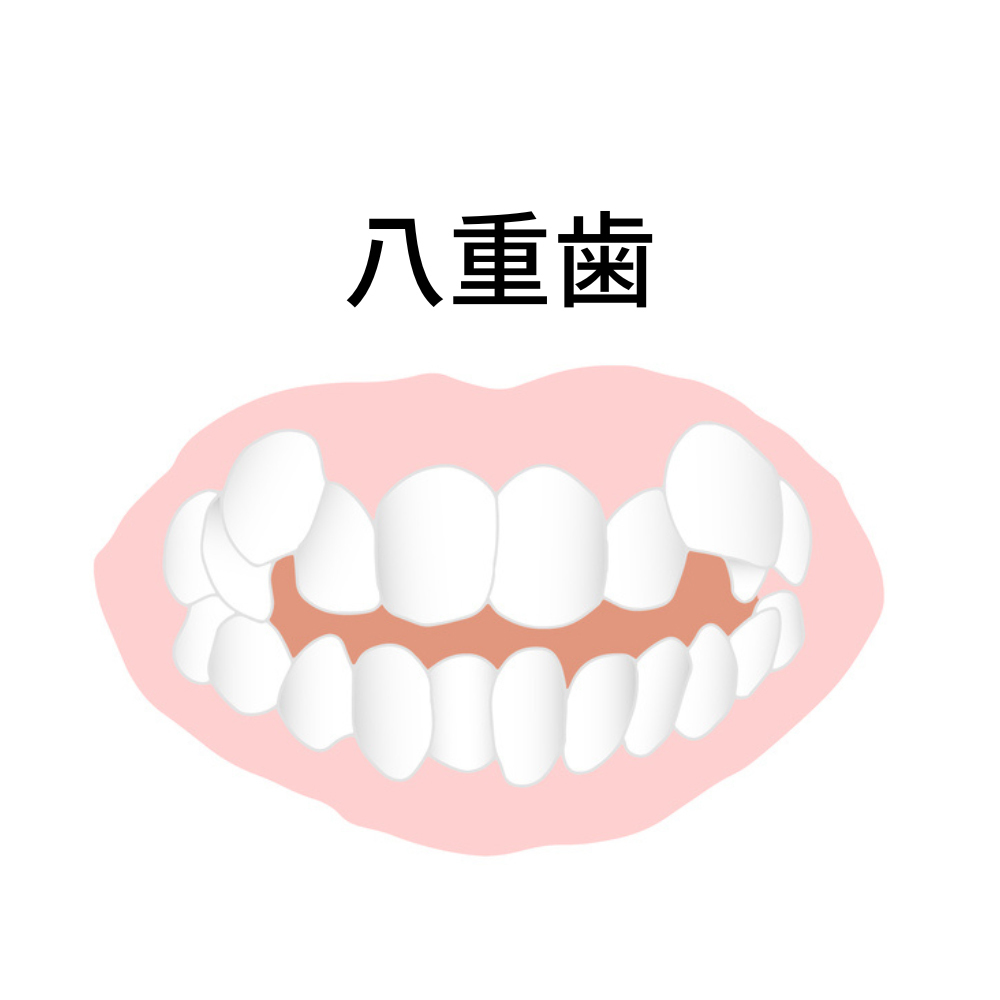 八重歯のインビザラインで後悔・失敗しないために