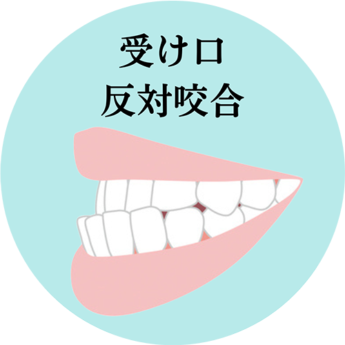 受け口