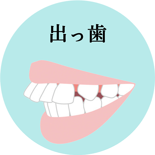 出っ歯