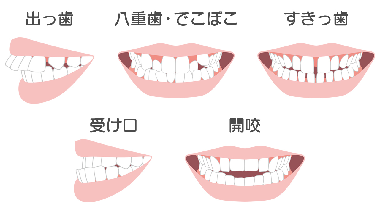 様々な歯並びの症状