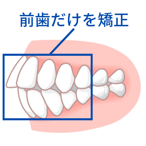 前歯だけを矯正