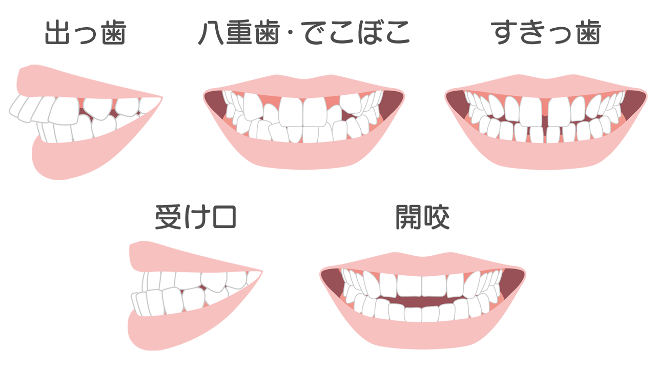 マウスピース矯正ができない症例でも大丈夫- 浜松市矯正歯科相談室