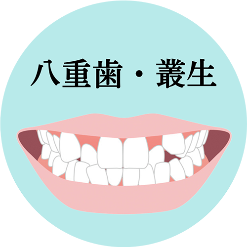 八重歯・叢生